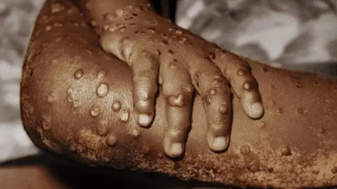 Kenya confirms second mpox case in truck driver from Uganda